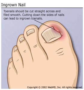Ingrown Toe Nail