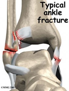 Ankle Fracture