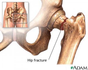 Hip Fractures