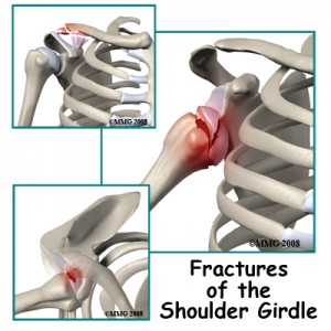 Shoulder Fractures