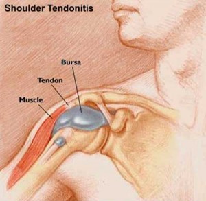 Shoulder Tendonitis